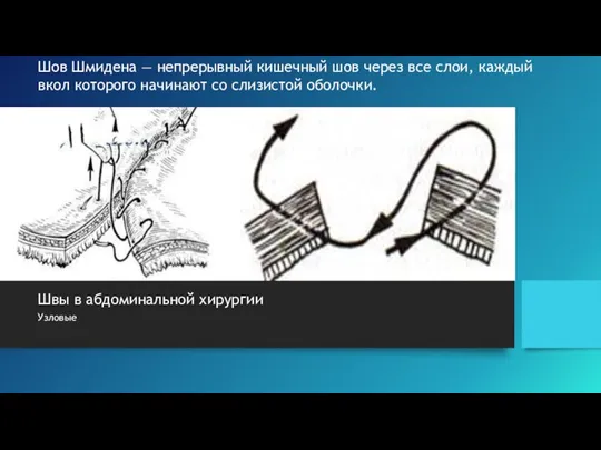 Швы в абдоминальной хирургии Узловые Шов Шмидена — непрерывный кишечный шов через