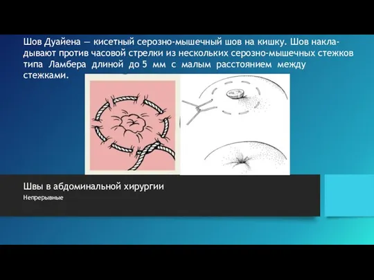 Швы в абдоминальной хирургии Непрерывные Шов Дуайена — кисетный серозно-мышечный шов на