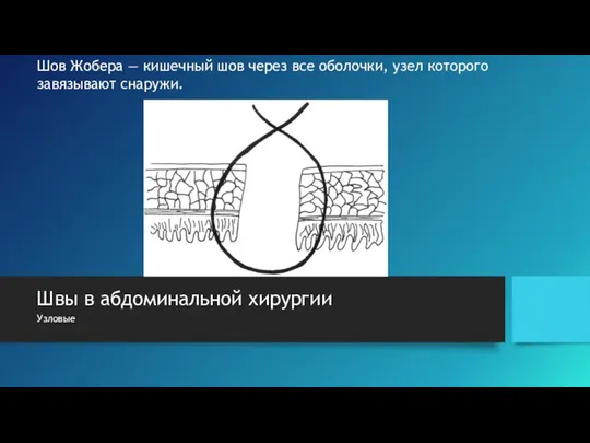 Швы в абдоминальной хирургии Узловые Шов Жобера — кишечный шов через все