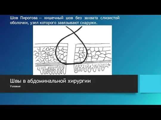 Швы в абдоминальной хирургии Узловые Шов Пирогова — кишечный шов без захвата
