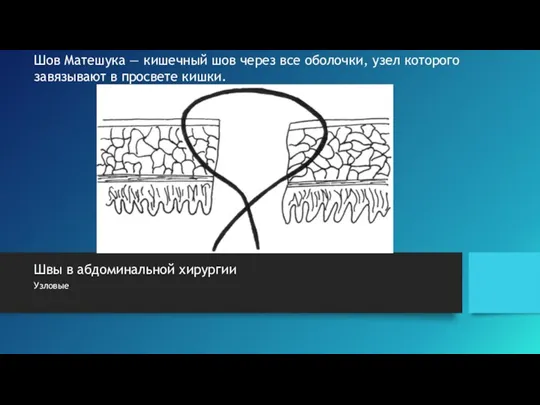 Швы в абдоминальной хирургии Узловые Шов Матешука — кишечный шов через все