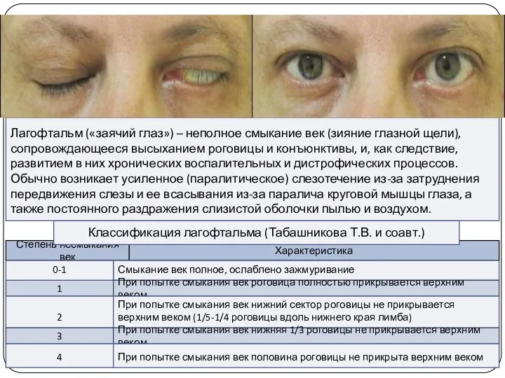Лагофтальм («заячий глаз») – неполное смыкание век (зияние глазной щели), сопровождающееся высыханием