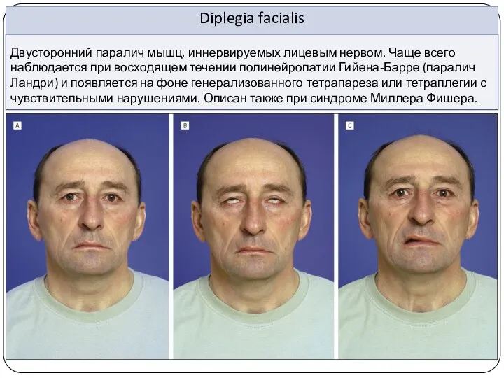 Diplegia facialis Двусторонний паралич мышц, иннервируемых лицевым нервом. Чаще всего наблюдается при