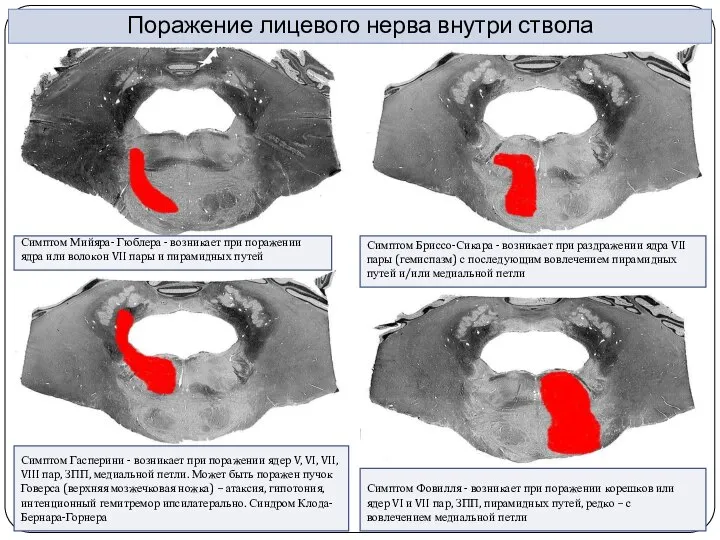 Поражение лицевого нерва внутри ствола Симптом Бриссо-Сикара - возникает при раздражении ядра