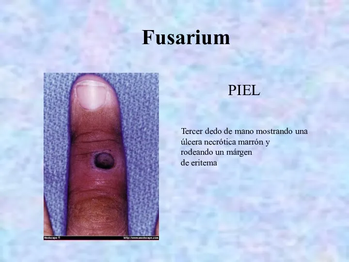 Fusarium PIEL Tercer dedo de mano mostrando una úlcera necrótica marrón y