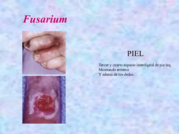 Tercer y cuarto espacio interdigital de pie izq. Mostrando eritema Y edema