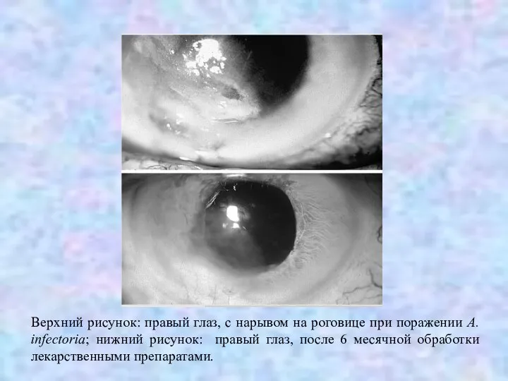 Верхний рисунок: правый глаз, с нарывом на роговице при поражении A. infectoria;