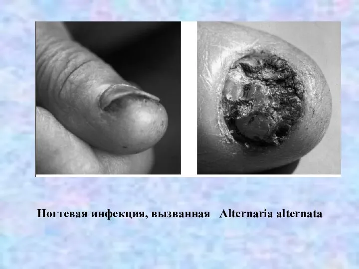 Ногтевая инфекция, вызванная Alternaria alternata