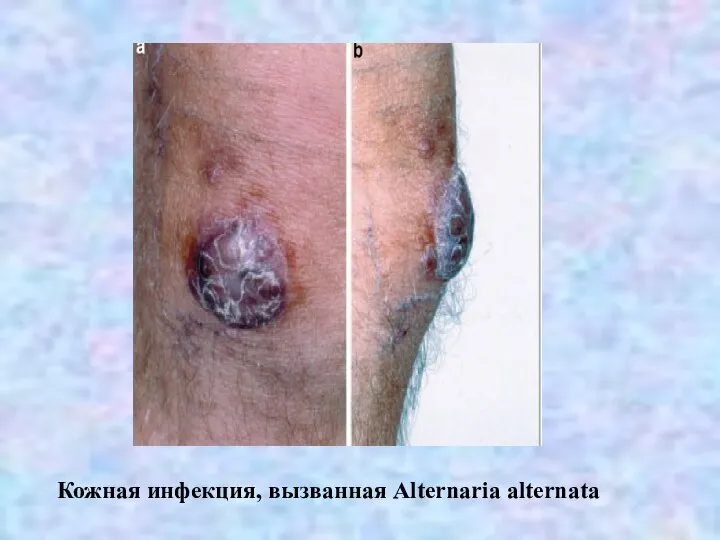 Кожная инфекция, вызванная Alternaria alternata