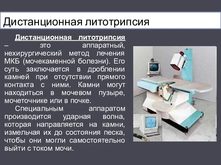 Дистанционная литотрипсия Дистанционная литотрипсия – это аппаратный, нехирургический метод лечения МКБ (мочекаменной