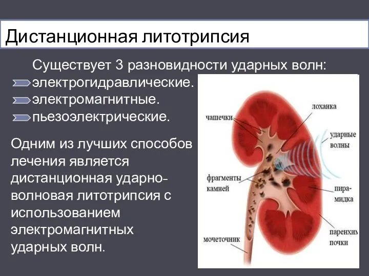 Дистанционная литотрипсия Существует 3 разновидности ударных волн: электрогидравлические. электромагнитные. пьезоэлектрические. Одним из