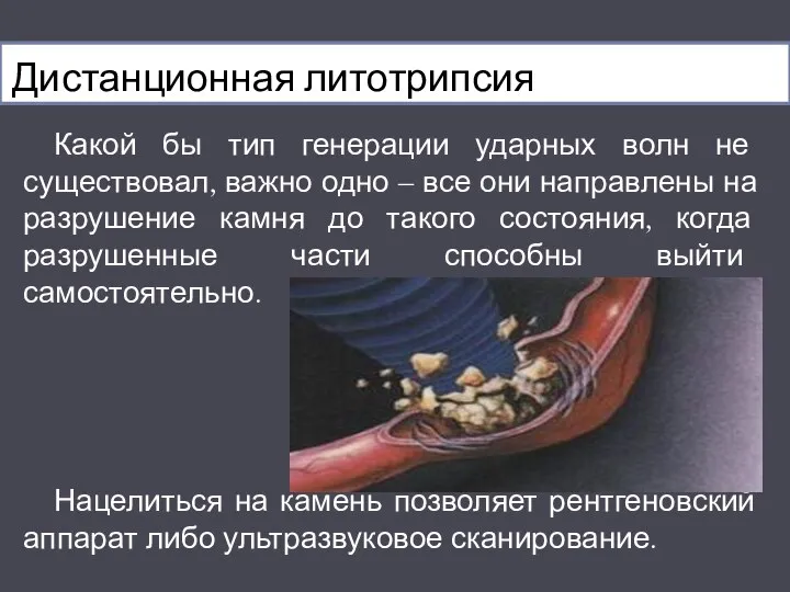 Дистанционная литотрипсия Какой бы тип генерации ударных волн не существовал, важно одно