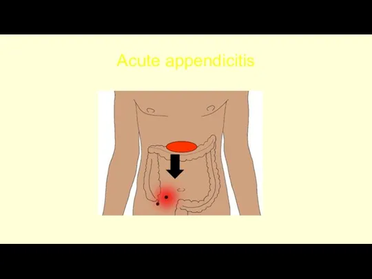 Acute appendicitis