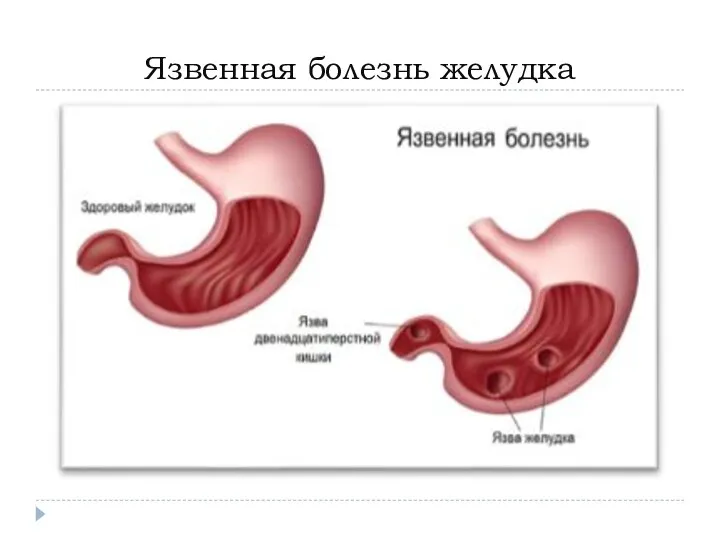 Язвенная болезнь желудка