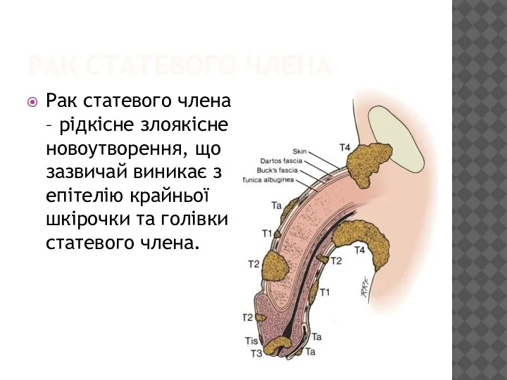 РАК СТАТЕВОГО ЧЛЕНА Рак статевого члена – рідкісне злоякісне новоутворення, що зазвичай