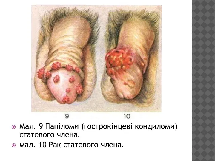 Мал. 9 Папіломи (гострокінцеві кондиломи) статевого члена. мал. 10 Рак статевого члена.