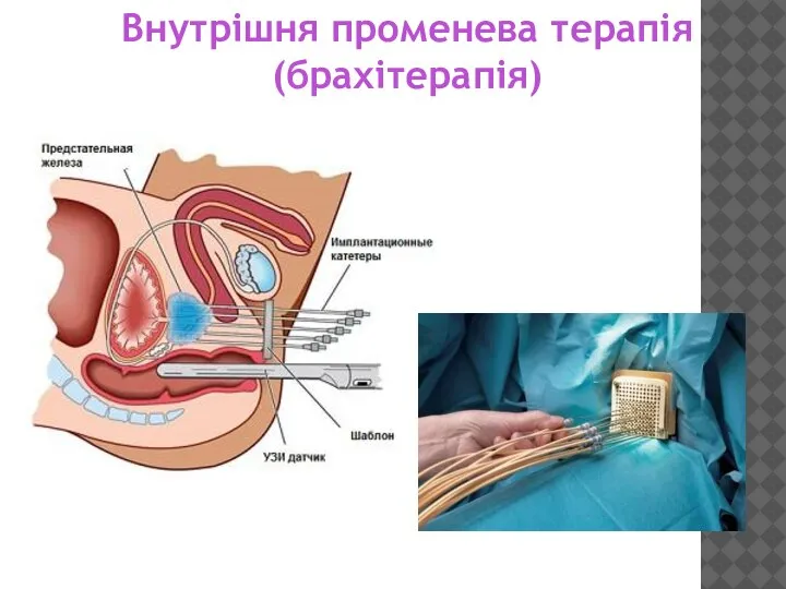 Внутрішня променева терапія (брахітерапія)