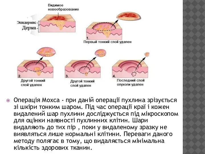 Операція Мохса - при даній операції пухлина зрізується зі шкіри тонким шаром.