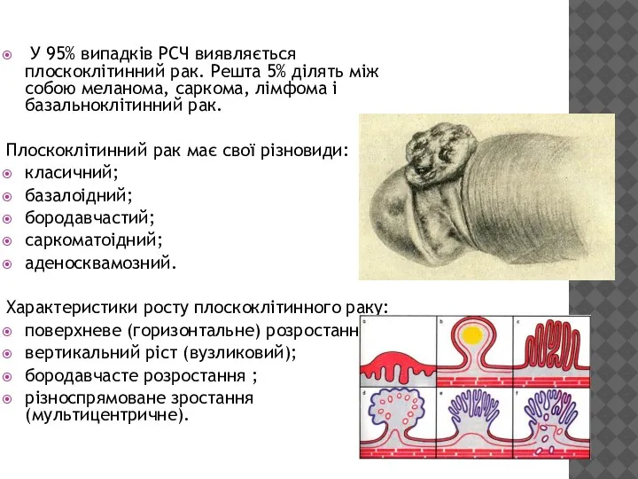 У 95% випадків РСЧ виявляється плоскоклітинний рак. Решта 5% ділять між собою