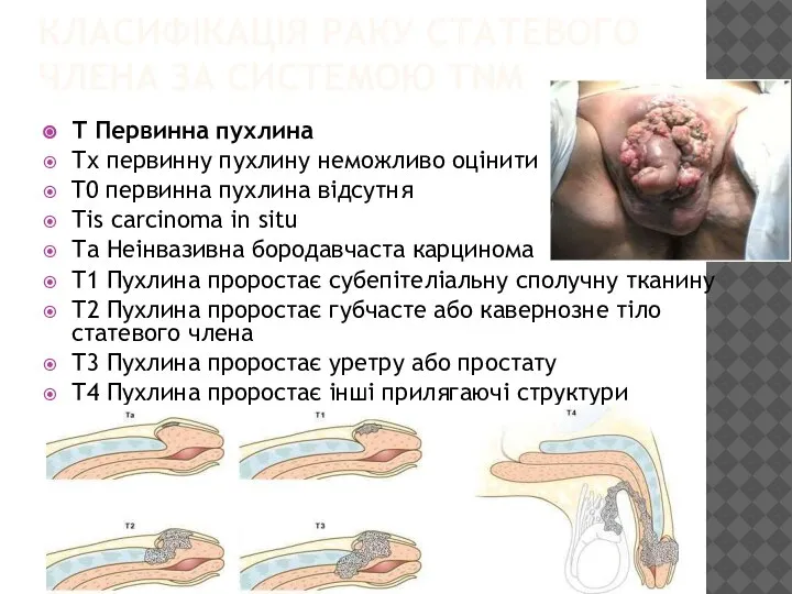 КЛАСИФІКАЦІЯ РАКУ СТАТЕВОГО ЧЛЕНА ЗА СИСТЕМОЮ TNM Т Первинна пухлина Тх первинну