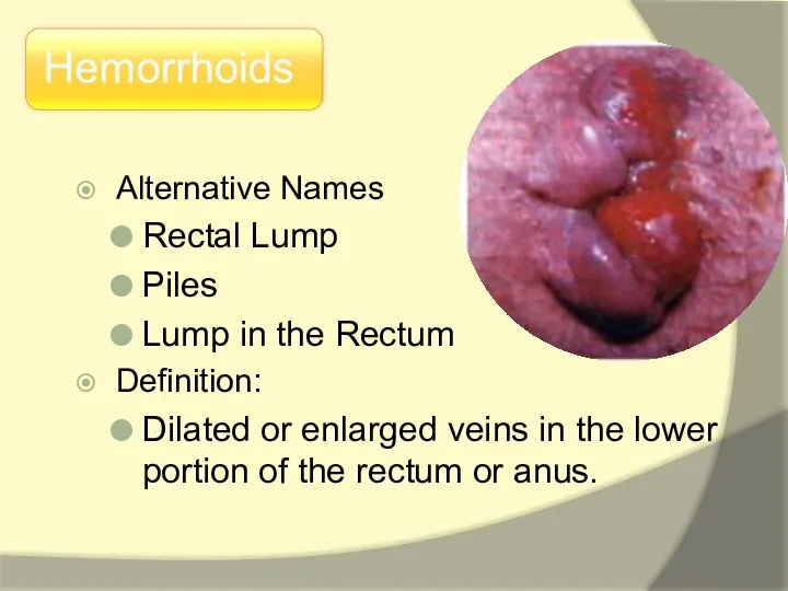 Alternative Names Rectal Lump Piles Lump in the Rectum Definition: Dilated or