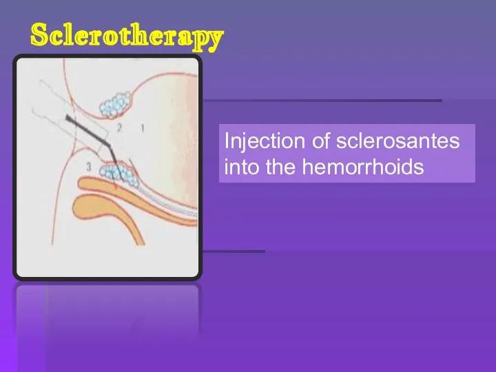 Sclerotherapy Injection of sclerosantes into the hemorrhoids