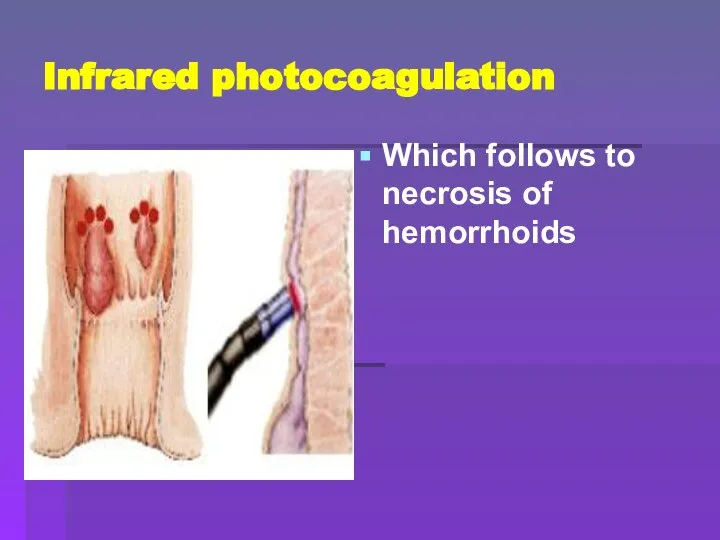 Infrared photocoagulation Which follows to necrosis of hemorrhoids