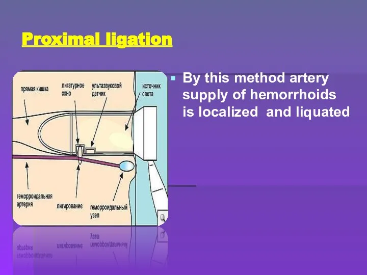 Proximal ligation By this method artery supply of hemorrhoids is localized and liquated