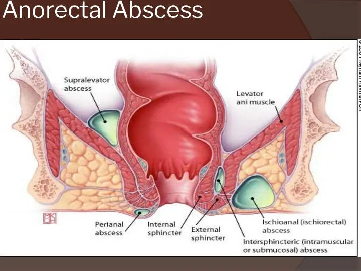 Anorectal Abscess