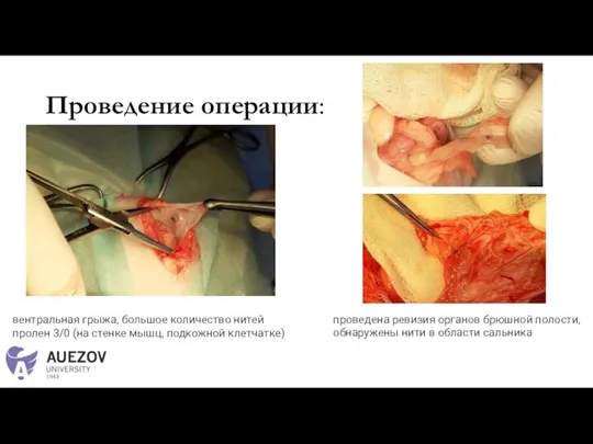 Проведение операции: вентральная грыжа, большое количество нитей пролен 3/0 (на стенке мышц,