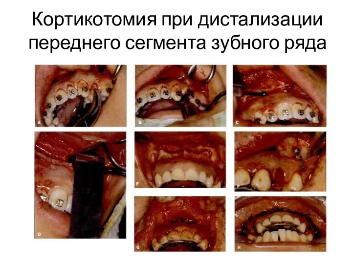 Кортикотомия при дистализации переднего сегмента зубного ряда