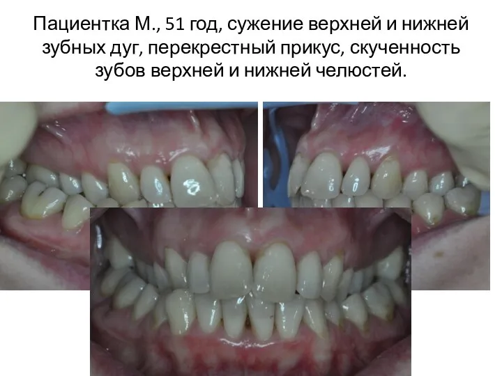Пациентка М., 51 год, сужение верхней и нижней зубных дуг, перекрестный прикус,