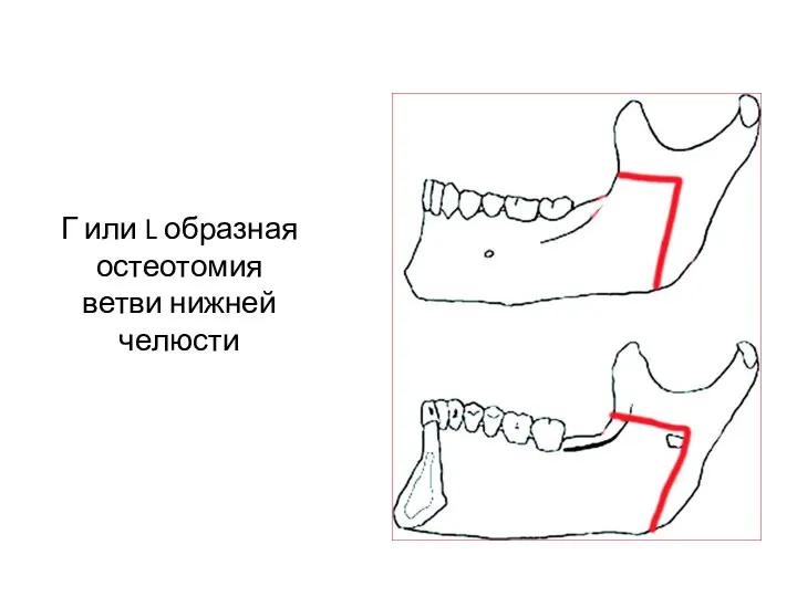 Г или L образная остеотомия ветви нижней челюсти