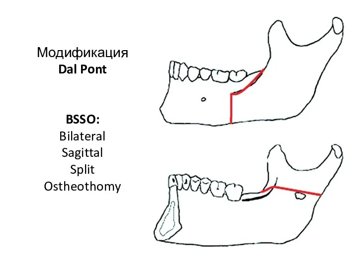 Модификация Dal Pont BSSO: Bilateral Sagittal Split Ostheothomy