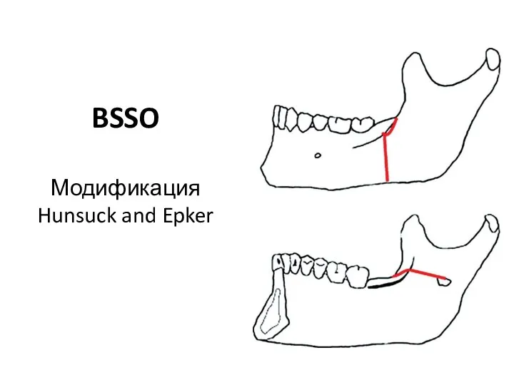 BSSO Модификация Hunsuck and Epker