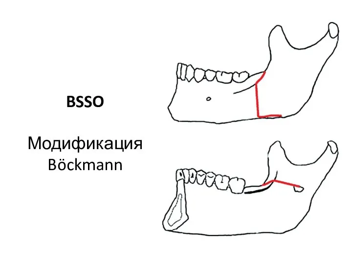 BSSO Модификация Böckmann