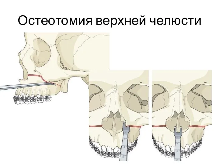 Остеотомия верхней челюсти