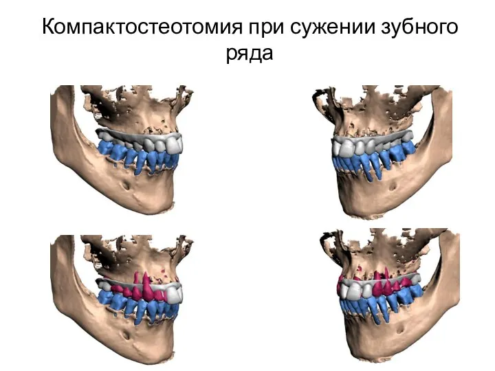 Компактостеотомия при сужении зубного ряда