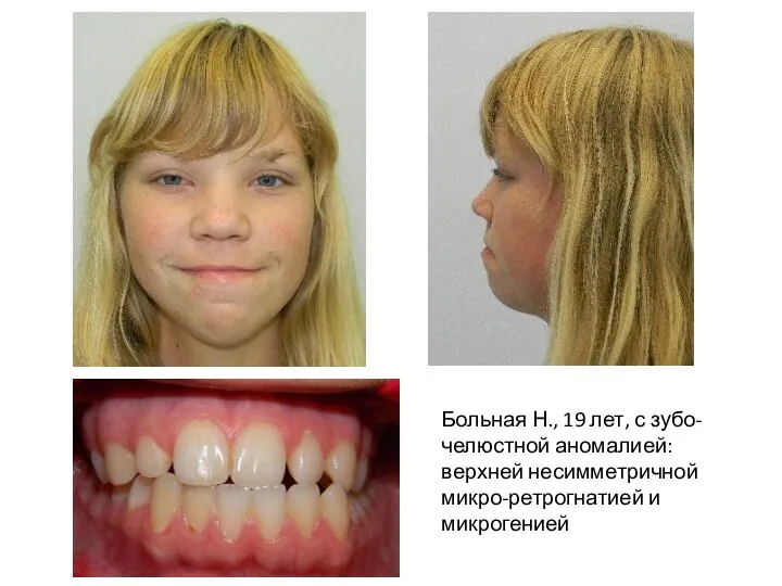 Больная Н., 19 лет, с зубо-челюстной аномалией: верхней несимметричной микро-ретрогнатией и микрогенией
