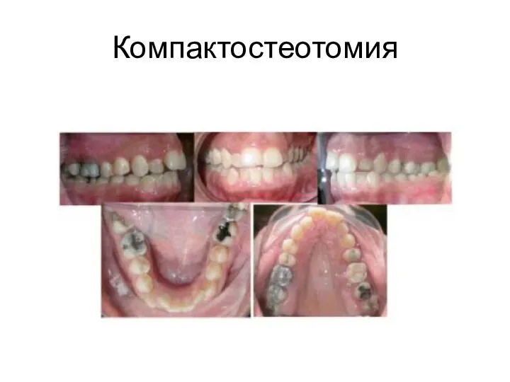 Компактостеотомия