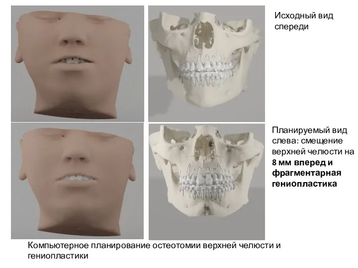 Компьютерное планирование остеотомии верхней челюсти и гениопластики Исходный вид спереди Планируемый вид