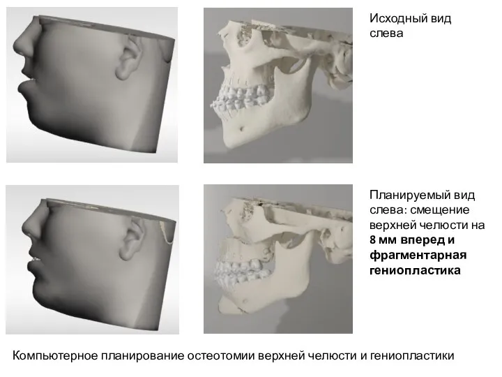 Компьютерное планирование остеотомии верхней челюсти и гениопластики Исходный вид слева Планируемый вид