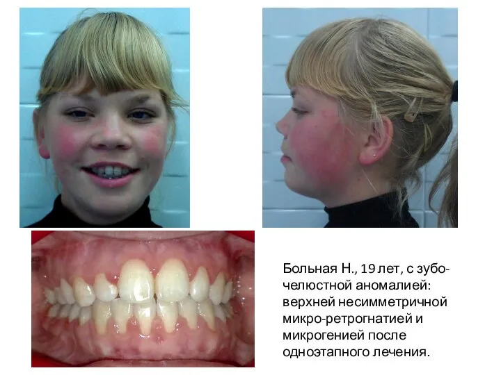 Больная Н., 19 лет, с зубо-челюстной аномалией: верхней несимметричной микро-ретрогнатией и микрогенией после одноэтапного лечения.