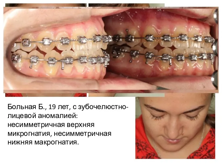Больная Б., 19 лет, с зубочелюстно-лицевой аномалией: несимметричная верхняя микрогнатия, несимметричная нижняя макрогнатия.