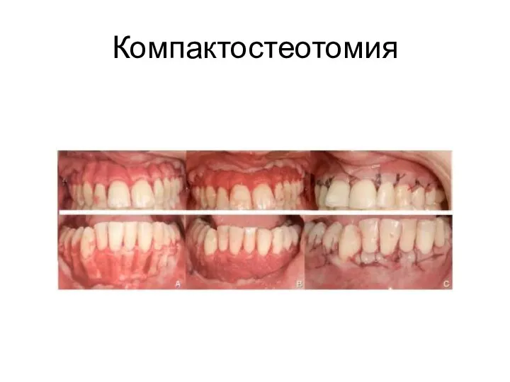 Компактостеотомия