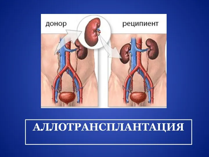 АЛЛОТРАНСПЛАНТАЦИЯ