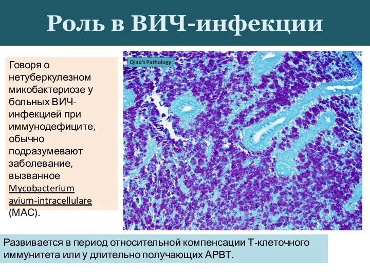 Говоря о нетуберкулезном микобактериозе у больных ВИЧ‐инфекцией при иммунодефиците, обычно подразумевают заболевание,