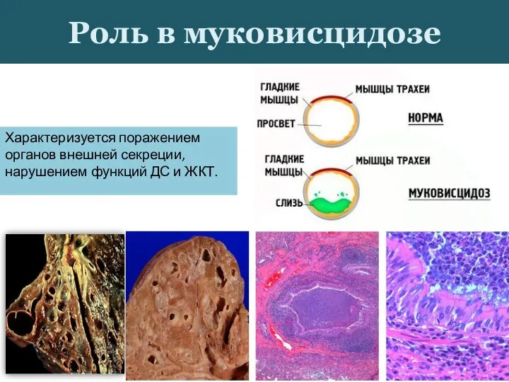 Роль в муковисцидозе Характеризуется поражением органов внешней секреции, нарушением функций ДС и ЖКТ.