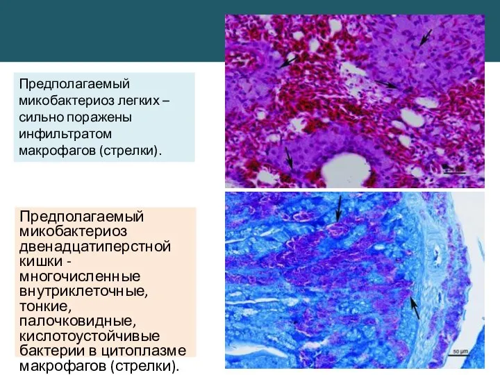 Предполагаемый микобактериоз двенадцатиперстной кишки - многочисленные внутриклеточные, тонкие, палочковидные, кислотоустойчивые бактерии в