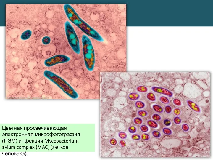 Цветная просвечивающая электронная микрофотография (ПЭМ) инфекции Mycobacterium avium complex (MAC) (легкое человека).
